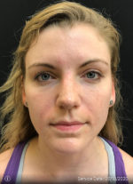 Around The Eye Fillers