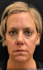 Botox Cosmetic and Dysport