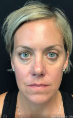 Botox Cosmetic and Dysport