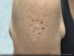 Basal Cell Carcinoma