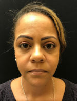 Botox Cosmetic and Dysport