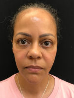 Botox Cosmetic and Dysport