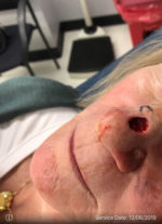 Dermatologic Surgery