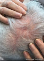 Dermatologic Surgery