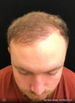 NeoGraft
