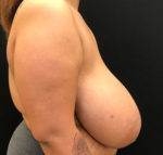 Breast Reduction