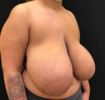 Breast Reduction