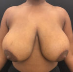 Breast Reduction