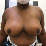 Breast Reduction