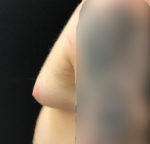 Gynecomastia