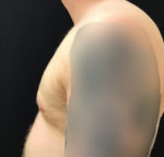 Gynecomastia