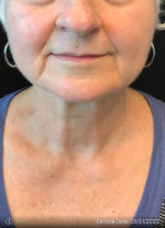 Around The Mouth Fillers