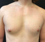 Gynecomastia