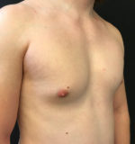 Gynecomastia
