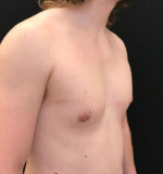 Gynecomastia