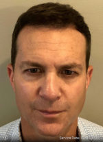 NeoGraft