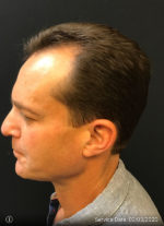 NeoGraft