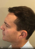 NeoGraft