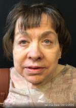 Around The Eye Fillers