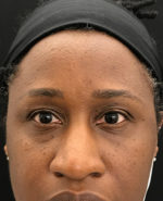 Around The Eye Fillers