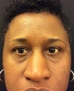 Around The Eye Fillers