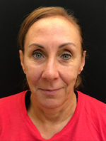 Around The Eye Fillers