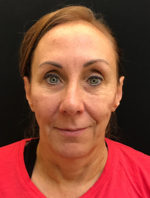 Around The Eye Fillers