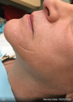 Around The Mouth Fillers