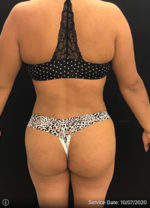 Liposuction