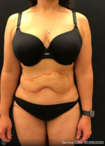 Liposuction