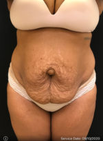Tummy Tuck