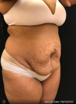 Tummy Tuck