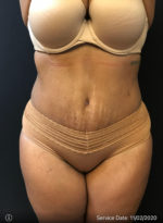 Tummy Tuck
