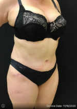 Tummy Tuck