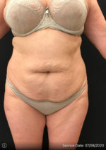 Tummy Tuck