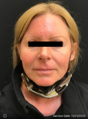 Botox Cosmetic and Dysport