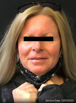 Botox Cosmetic and Dysport