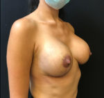 Breast Lift