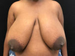 Breast Reduction