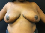 Breast Reduction