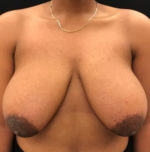 Breast Reduction