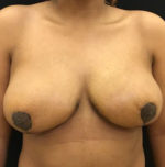 Breast Reduction