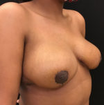 Breast Reduction
