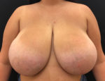 Breast Reduction