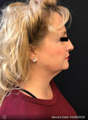 Facetite