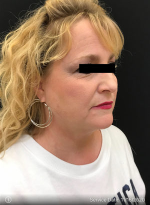 Facetite