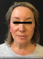 Around The Eye Fillers