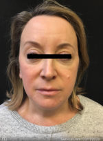 Around The Eye Fillers