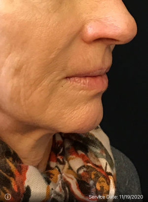 Around The Mouth Fillers