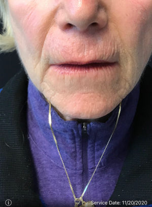 Around The Mouth Fillers